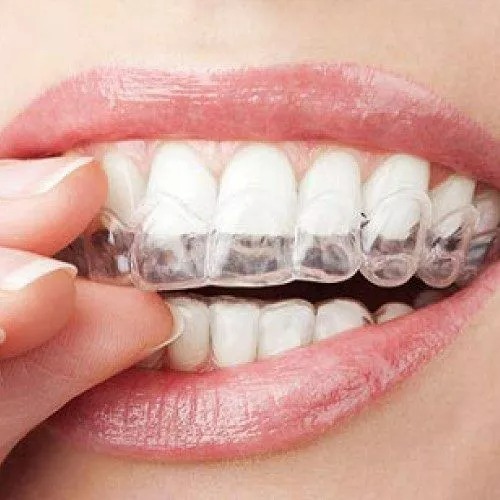 9 Things You Need To Know About Invisalign Braces
